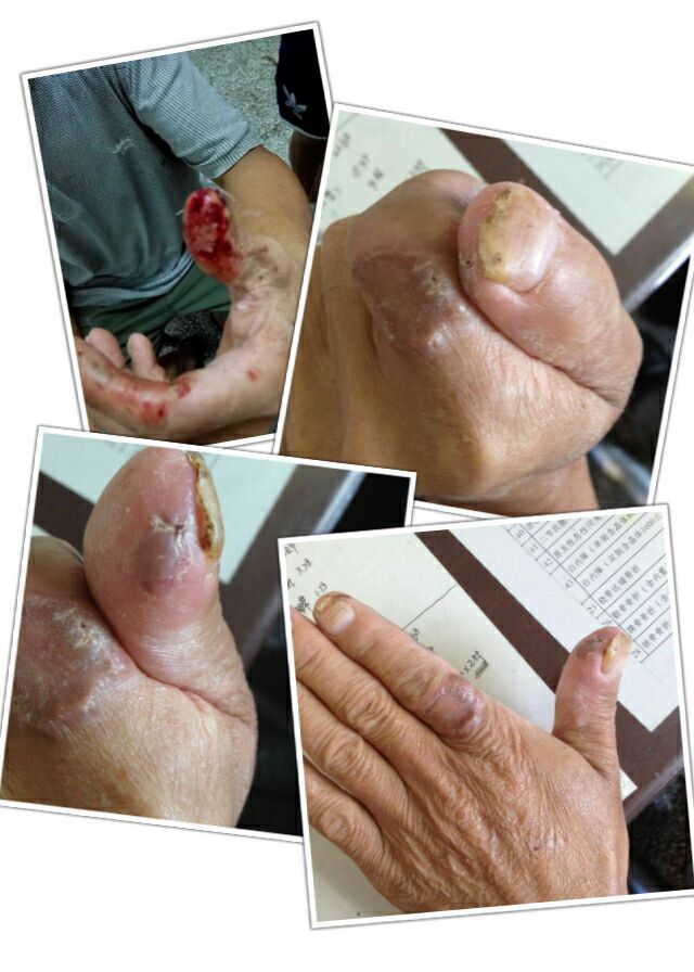 手指割伤担心残疾 巧法施治恢复旧貌.jpg
